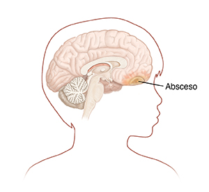 Contorno de la cabeza de un niño de lado mostrando la cabeza y el cerebro. Hay un absceso en la parte delantera del cerebro.
