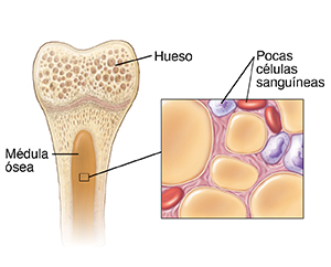 Corte transversal de un hueso que muestra la médula ósea y un recuadro donde puede verse la médula ósea con anemia aplásica.