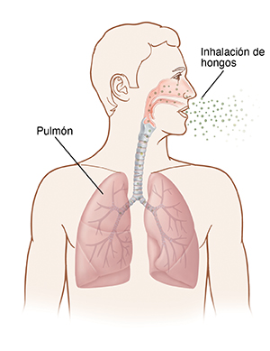Contorno de una cabeza y un pecho humanos con la cabeza girada hacia un lado. Pueden verse el interior de la nariz, las vías respiratorias y los pulmones. Se inspira el hongo por la nariz y los pulmones.